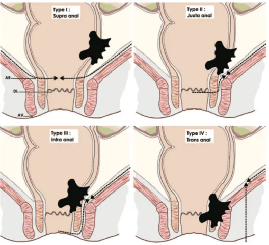 Fig 3 (14) Classification chirurgicale des cancers du bas rectum 