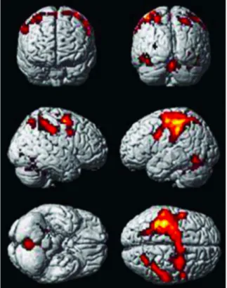 Figure  2  :  Activations corticales  lors de  la  performance musicale  (p&gt;0,05),  activation  du cortex  primaire  sensitivo-moteur  de  l’hémisphère  gauche,  du  cortex  prémoteur  et  du  cervelet  de  façon  bilatérale,  du  precuneus du lobe pari