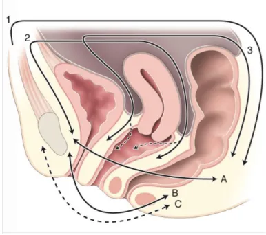 Figure 2 : Limites de l'exérèse dans l'exentération antérieure sans périnectomie    
