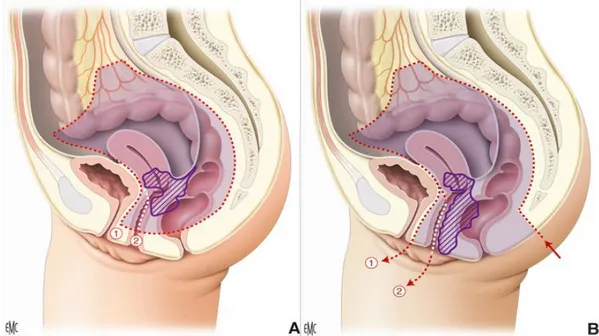Figure 3 : Limites de l'exérèse dans l'exentération postérieure sans périnectomie en réséquant seulement  la paroi postérieure du vagin (A)(2) ou la totalité (A)(1) ou bien avec périnectomie (B)(1) ou (B)(2)