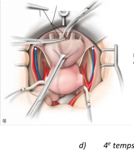 Figure 7 : Décollement de la face antérieure de la vessie et abord du col  vésical. 