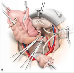 Figure 19 : Après avoir réalisé la colpotomie, les ailerons du  rectum sont liés et sectionnés.
