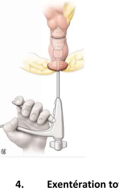 Figure  22 :  L’anastomose,  si  elle  est  possible,  peut  être  manuelle ou mécanique à l’aide de la pince EEA