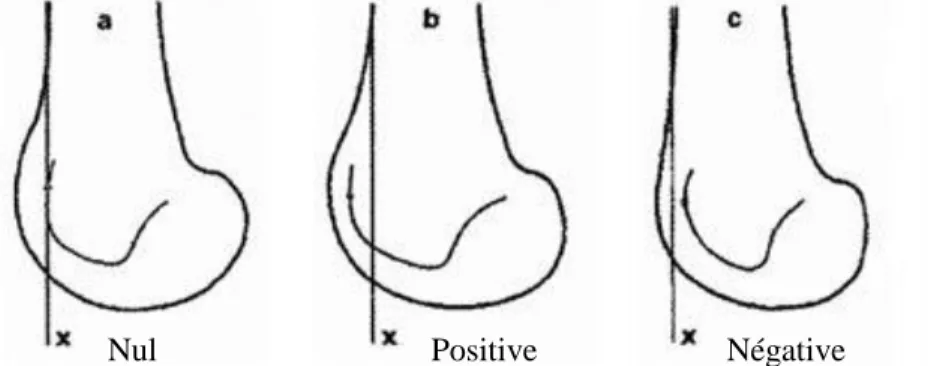 Figure 5 : Saillie de la trochlée 