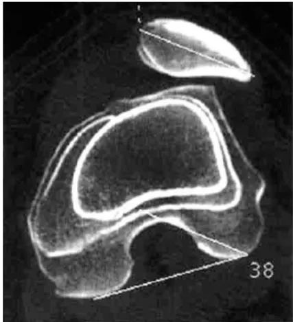 Figure 9 : Coupe axiale d’un genou au scan- scan-ner, montrant une bascule rotulienne (42)