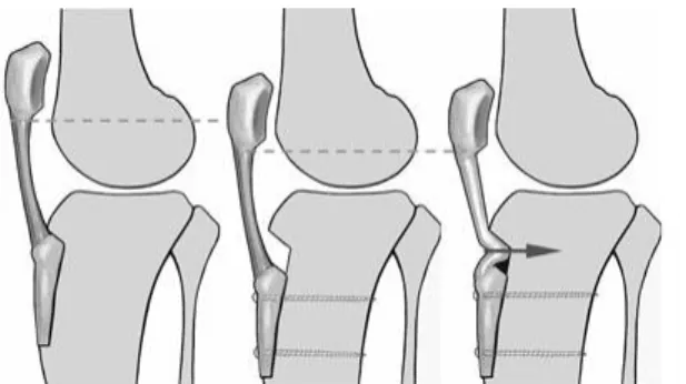 Figure 18 : Abaissement de la TTA avec ou sans ténodèse  du tendon rotulien.(42) 