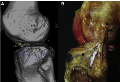 Figure 4: Correspondance entre la fracture de Segond et l'insertion tibiale du LAL. Van der watt et al (22)