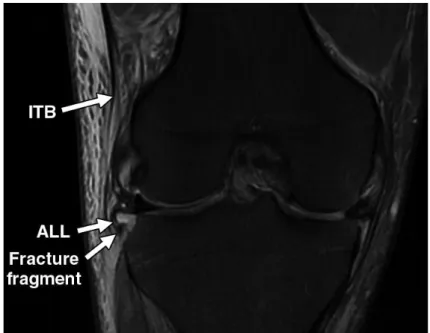 Figure 6: IRM du genou montrant le LAL attaché à une fracture de Segond (24)