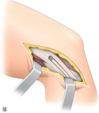 Figure 10A : Technique de Christel (34)