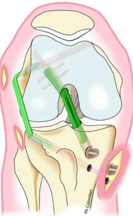 Figure 11: Technique de P. Imbert (34) 