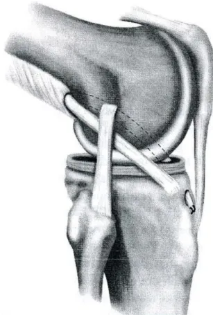 Figure 13: Technique de Mac Intosh, 2ème manière (41) 