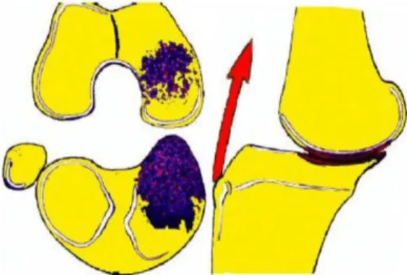 Figure  7  (59) : Disparition  progressive  du  ménisque  médial  provoquant  une  subluxation postérieure progressive du condyle médial avec apparition d’une cupule postéro-médiale