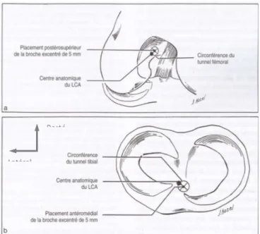 Figure 10 (87): Schémas représentant le positionnement des tunnels  Posté