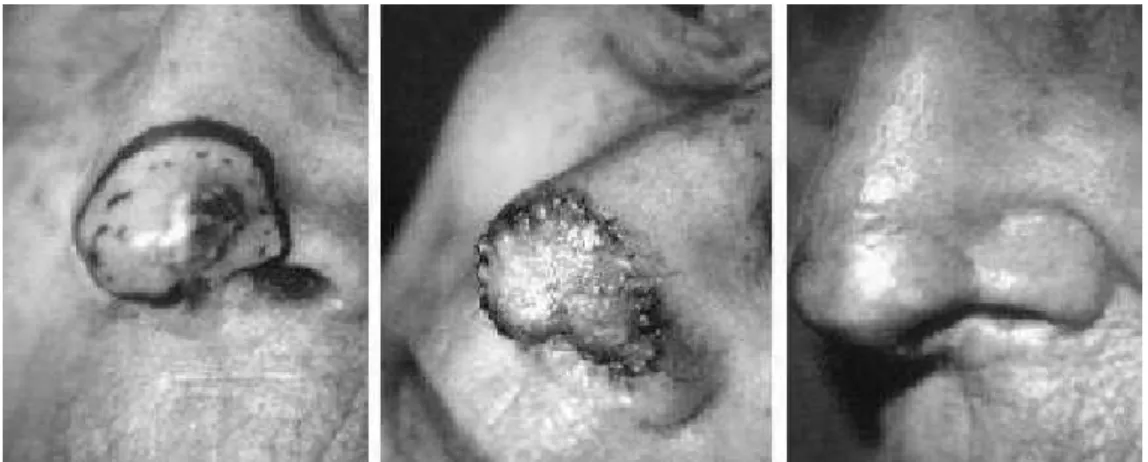 Figure 10 : greffe de peau pour une perte de substance de la pointe du nez 