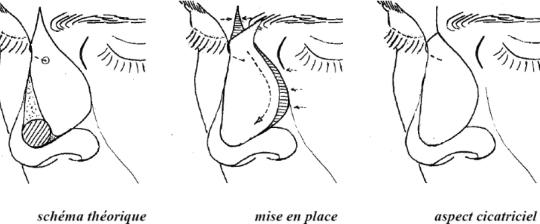 Figure 13 : lambeau naso-glabellaire de Rieger pour une perte de substance de la pointe du nez 