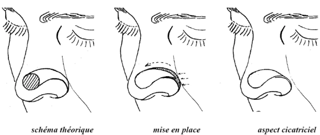 Figure 16 : lambeau myocutané transverse du nez pour une perte de  substance paramédiane de la pointe du nez 