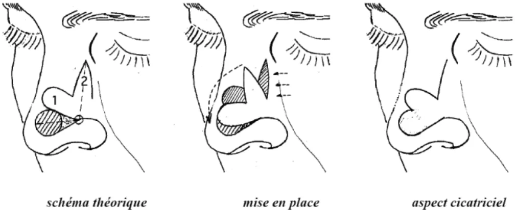 Figure 19 : lambeau bilobé pour une perte de substance de la pointe du nez 
