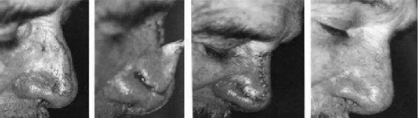 Figure 23 : lambeau en voile pour une perte de substance paramédiane et sus-apicale de           la pointe du nez  (JM