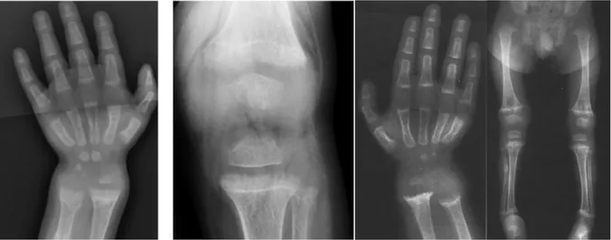 Figure 4 : Radiographies osseuses avec signes de rachitisme [9] [12] 