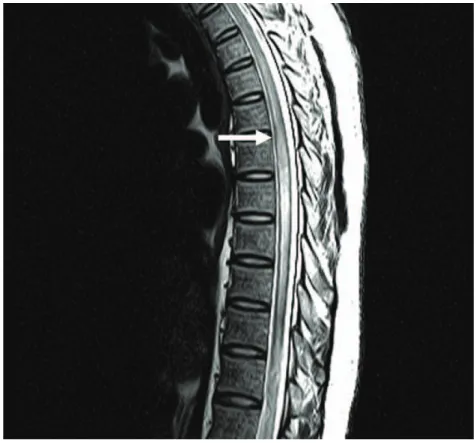 Figure 5 - Les images IRM en signal T2 à 4 semaines ont montré une progression   de l’augmentation du signal T2 jusqu’au niveau vertébral T6 (flèche)