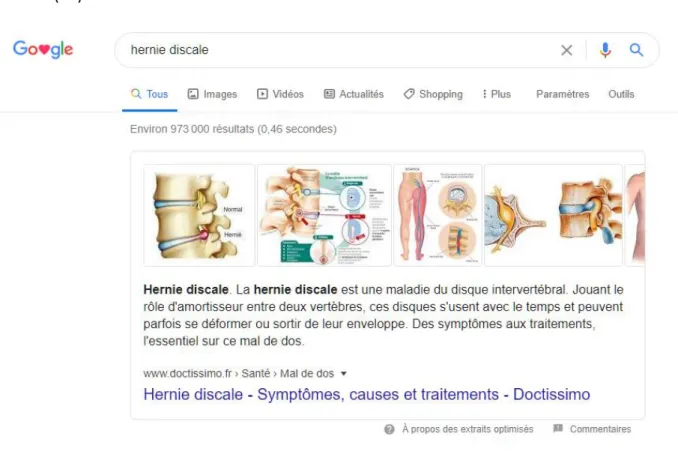 Figure 6 : Exemple de la Position Zéro d’une recherche Google® à partir des mots clés “hernie  discale” 