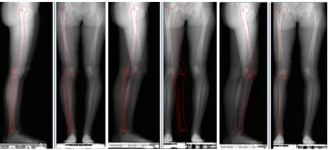 Fig. 3. Illustration of the manual process on views of healthy subjects. From the left to the right: skeletal personalised 3D reconstruction (first pair of images); import of the 3D surface model on flex knee position (second pair of images) and manual reg