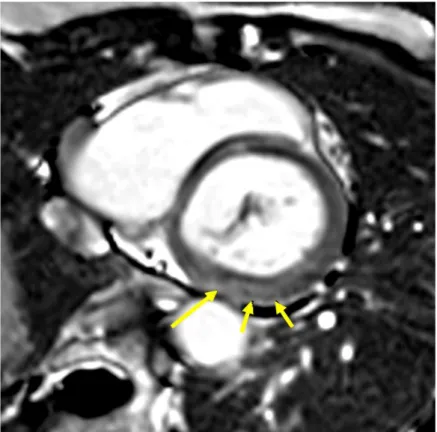 Figure 12 : Fibrose infero basale du VG en IRM myocardique 