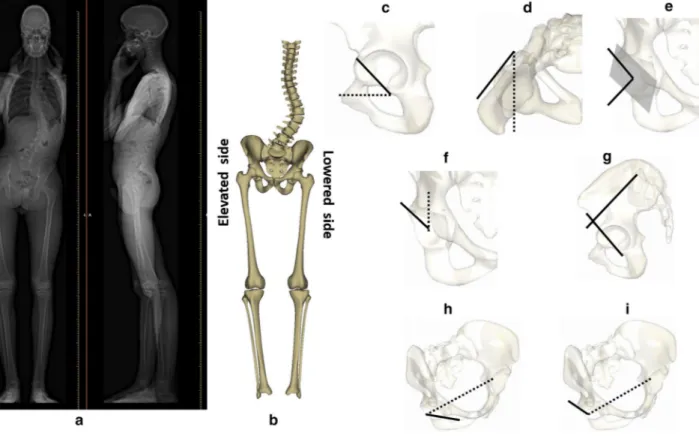 Fig. 1    a Full-body biplanar X-rays for a patient with adolescent idi- idi-opathic scoliosis, b 3D reconstructions of the spine, pelvis and lower  limbs with classification of elevated and lowered sides, c acetabular 