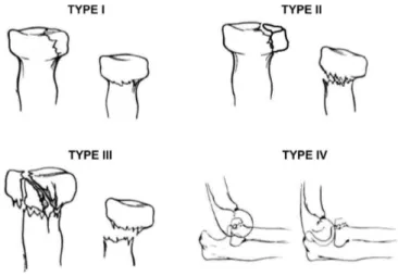 Figure 1 : Classification de Mason‐ Johnston 3.  modifiée Broberg et Morrey 4.  