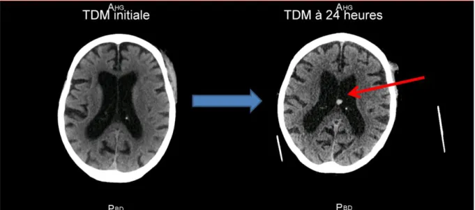 Figure 6: A gauche TDM à l'admission, à droite TDM à 24 heures. TDM = tomodensitométrie 
