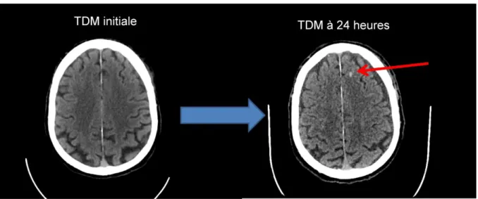 Figure 8 : gauche la TDM à l’admission, à droite la TDM de contrôle. TDM= tomodensitométrie 