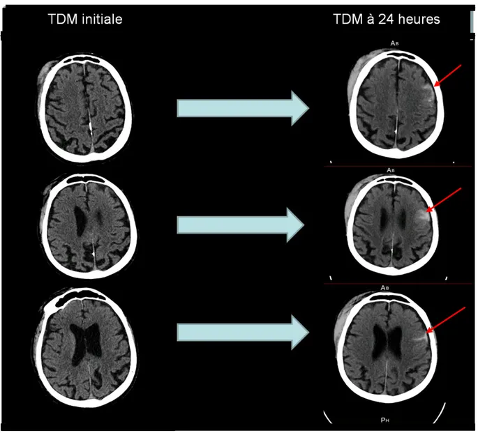 Figure 10 : A gauche la TDM à l’admission, à droite la TDM de contrôle. TDM = tomodensitométrie 