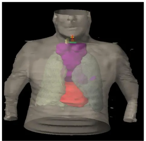 Figure  13 :  Reconstruction  3D,  scanner  de  centrage,  et  simulation  de  traitement  (3  faisceaux)  d’un  patient  T1bN3  avec  une  lésion  primitive  distale