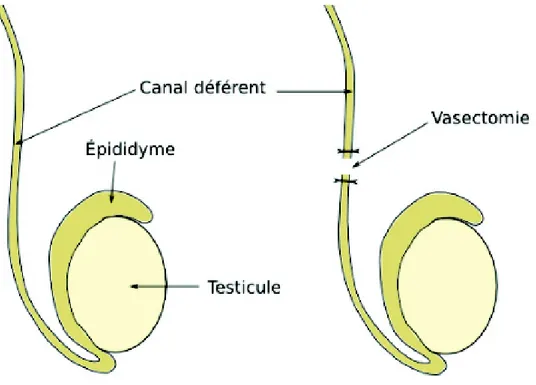 Figure 5 Principe de la vasectomie (10) 