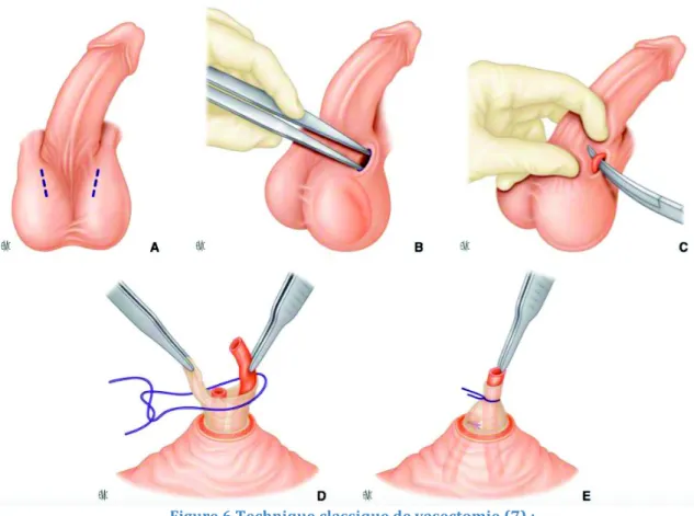 Figure 6 Technique classique de vasectomie (7) :  A. Incision 