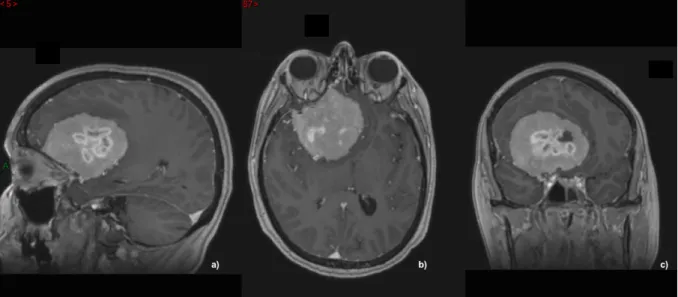 Figure   5.   Méningiome   sphénoïdal   droit,   vu   en   séquence   IRM   pondérées   T1   avec   injection   de   Gadolinium
