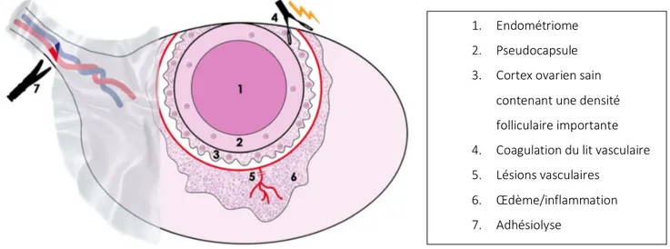 Figure 7 : Mécanismes associés à la perte folliculaire au cours de la chirurgie ovarienne   Carrillo et al