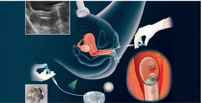 Figure 11 : Transfert embryonnaire intra-utérin  http://www.cliniqueovo.com 