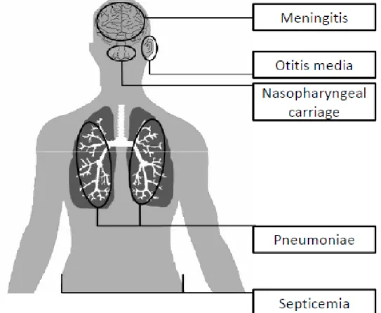 Figure  1.2.  Infections  caused  by  S.  pneumoniae.  All  pneumococcal  diseases  are  preceded  by  nasopharyngeal  carriage,  after  which  the  bacterium  can  spread  to  the  middle ear causing otitis media or disseminate to the lungs causing pneumo