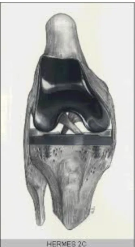 Figure A : Prothèse de Cloutier à conservation des ligaments croisés. 
