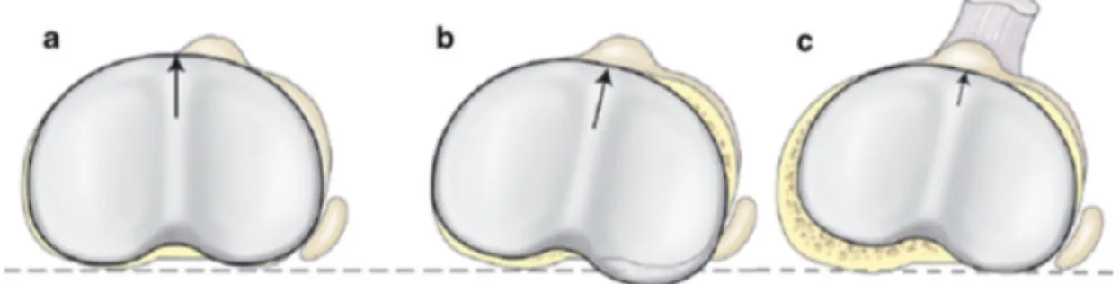 Figure  H. Différent positionnement d’un implant symétrique selon Bonnin et al. a. centré sur le bord  interne de la tubérosité tibiale antérieure(TTA) ; b.centré sur la TTA, occasionnant un débord postéro  externe ; c