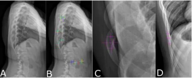 Fig. 1: (A) Original lateral x-ray and (B) source of reproducibility issues for points identification  of anatomical landmark for different users (one colour each)