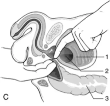 Figure 1 - Schéma de l'intervention par AVH  (d’après le collège français des urologues [19]) 