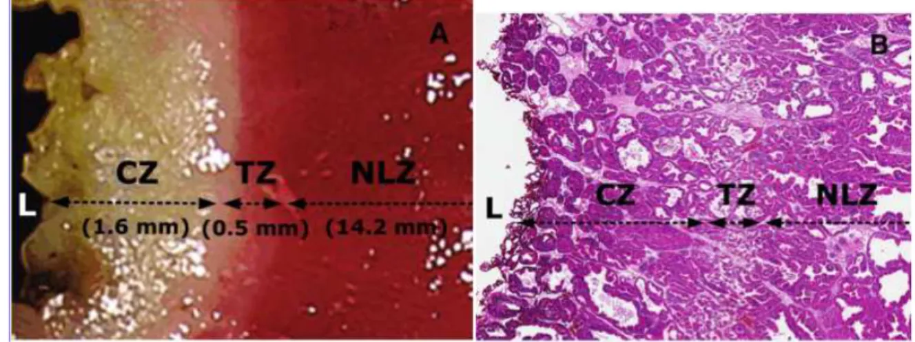 Figure 9 - Tissus prostatique macroscopique (A) et microscopique (B)   3 heures après PVP 120W [31] 