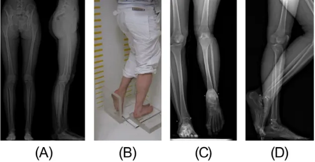 Fig. 1. (A) Face and proﬁle radiograph in “conventional” free standing position with shifted legs