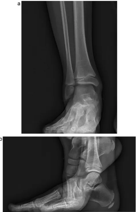 Fig. 4. A. Calcanei, coronal view: point AC cannot be identiﬁed on this view. B. Calcaneum, lateral view: point PC is difﬁcult to identify due to the insufﬁcient ossiﬁcation.