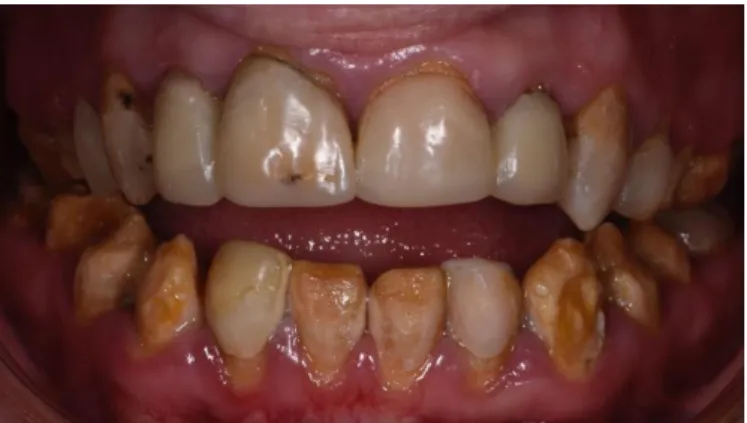 Figure 13 : Vue intra-buccale de face en occlusion 