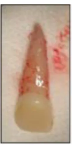 Figure 4: Photographie d’une incisive permanente expulsée présentant des cellules ligamentaires sur  la surface radiculaire 