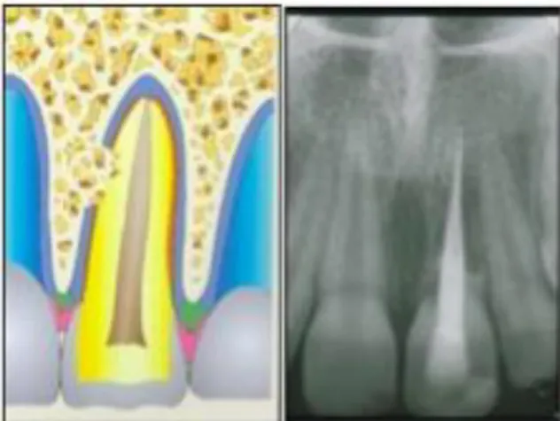 Figure 11: Illustration et radiographie d’une résorption de remplacement sur la dent n° 21 