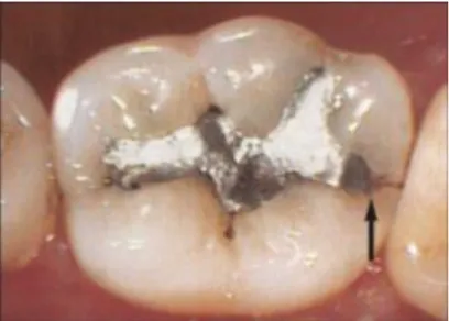 Figure 13 : mise en évidence d’une fêlure de la crête marginale d’une molaire mandibulaire en  présence d’un amalgame occlusal 